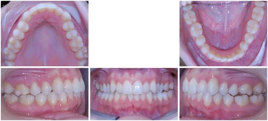 14-468-Progress 3-Custom 2 over 3.webp