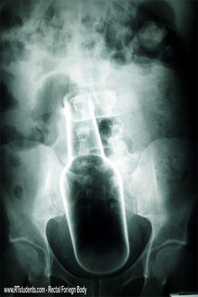 rectal-foriegn-body-xray.jpg